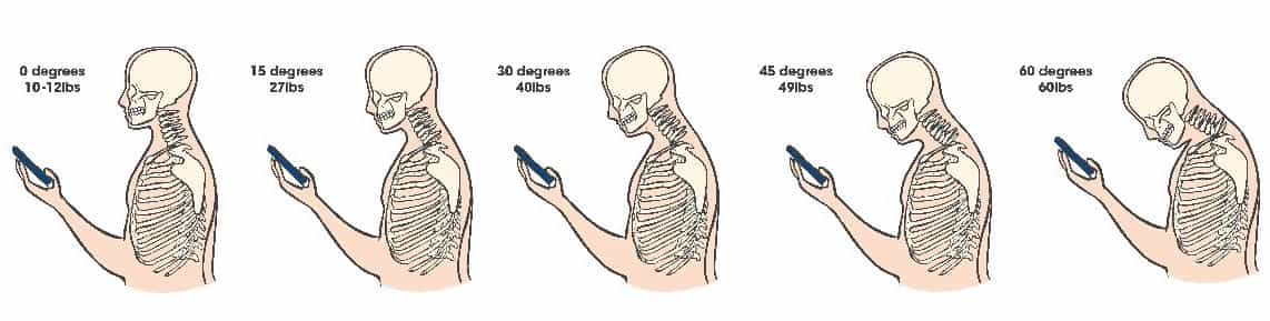 tech neck demonstration with skeletal model